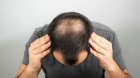 Kişilərdə saç tökülməsinə SON: Yeni vasitə hazırlandı