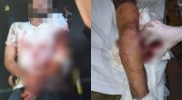 Ağdamda ermənilərin yaraladığı şirkət əməkdaşının SON DURUMU