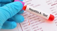 Azərbaycanda Hepatit A virusu ilə bağlı SON DURUM