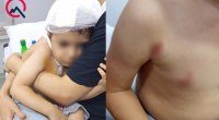 Masazırda 2 yaşlı uşağı it dişlədi – FOTO