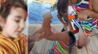 Lənkəranda qandonduran HADİSƏ – Ana isti qaşıqla 3 yaşlı qızının qolunu DAĞLADI – FOTO/VİDEO