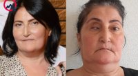 Bu klinika təzminat ödəyəcək - Burun düzəldəndə gözü zədələyib &ndash; FOTO