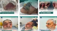 İt dişləməsi nəticəsində burnunu itirən xəstəyə yeni burun formalaşdırıldı - Azərbaycanda unikal əməliyyat &ndash; FOTO/VİDEO