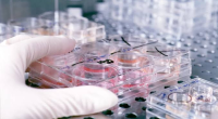 Azərbaycanda hepatitə yoluxanların sayı açıqlandı