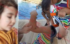 Lənkəranda qandonduran HADİSƏ – Ana isti qaşıqla 3 yaşlı qızının qolunu DAĞLADI – FOTO/VİDEO