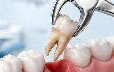 Stomatologiyanın “səhnə arxası” – Çəkilən çürük dişlər hara gedir?