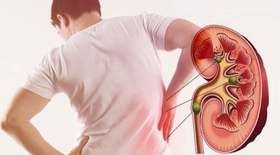 Böyrəkdə daşların yaranma səbəbləri açıqlandı