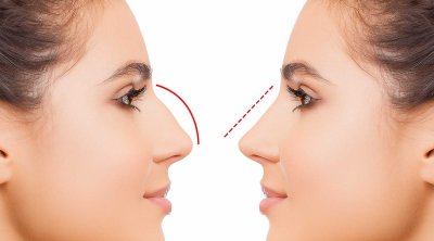 Azərbaycanda bu şəxslərə burun əməliyyatı pulsuz oldu