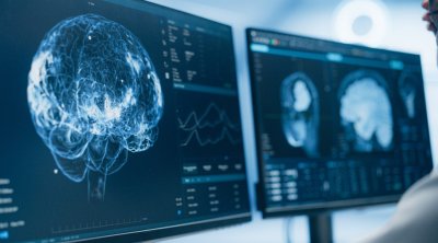 Alimlərdən Alzheimerlə mübarizə üçün qeyri-adi ÜSUL