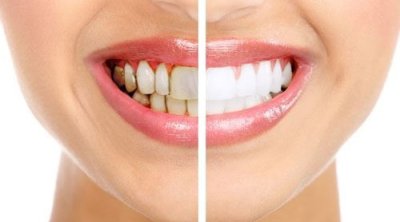 Həkim dişləri çürüdən qidaları AÇIQLADI