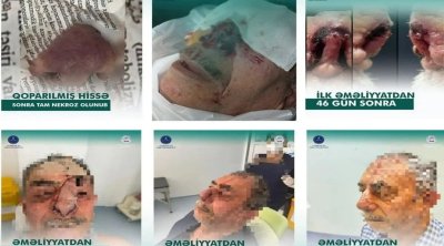 İt dişləməsi nəticəsində burnunu itirən xəstəyə yeni burun formalaşdırıldı - Azərbaycanda unikal əməliyyat &ndash; FOTO/VİDEO