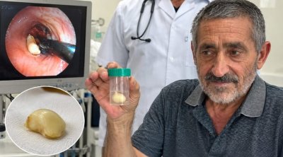 6 ay ağciyərində bu bitki ilə yaşadı &ndash; həqiqət xəstəxanada üzə çıxdı