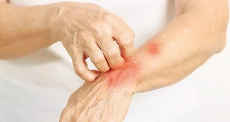 Tarixə gömdüyümüzü düşünürdük, yenidən dirildi &ndash; Cüzam epidemiyası geri qayıdır?