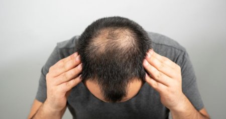 Kişilərdə saç tökülməsinə SON: Yeni vasitə hazırlandı