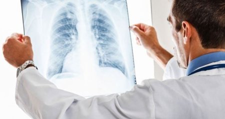 Vərəm xəstəliyinə niyə kişilər daha çox YOLUXUR?