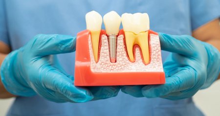 Ölü heyvan və insan sümüyündən hazırlanan diş implantları &ndash; Yeni sahibinin şəxsiyyətini dəyişə bilərmi?