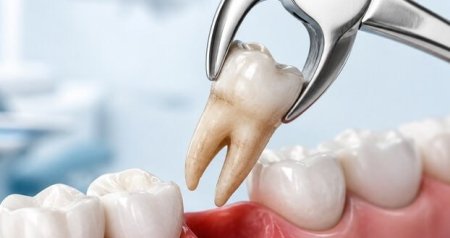 Stomatologiyanın &ldquo;səhnə arxası&rdquo; &ndash; Çəkilən çürük dişlər hara gedir?