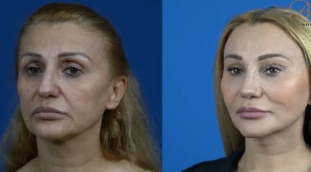 Plastik əməliyyat azərbaycanlı məşhuru bu hala saldı – FOTO / VİDEO