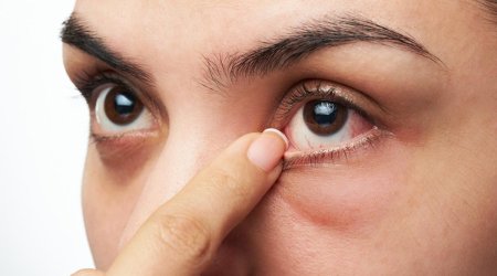 Gözaltında şişkinlik varsa, bunu edin