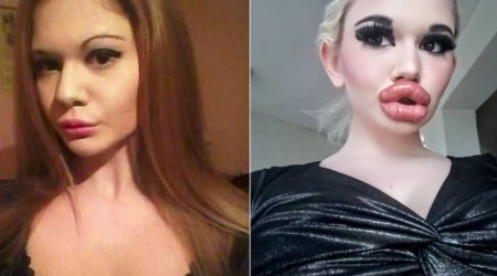 Dodağını 32 dəfə böyüdən model görünüşü ilə MƏƏTTƏL QOYDU - FOTO 