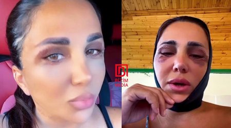 Zenfira gözəlləşmək üçün bıçaq altına uzandı - VİDEO
