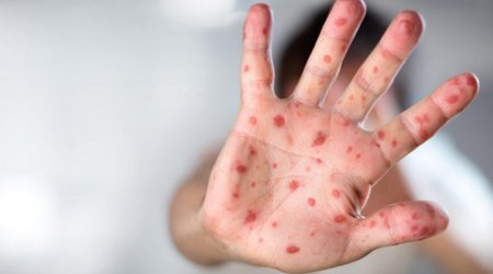 Bu ölkədə qızılca epidemiya ELAN EDİLDİ 