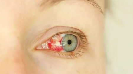 Göz qanaması ilə başlayan gizli virus yayılır