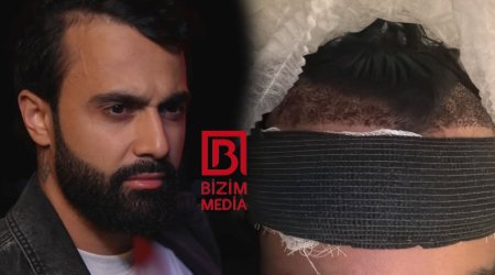 Hüseyn Həsənov saç əkdirdi - FOTO
