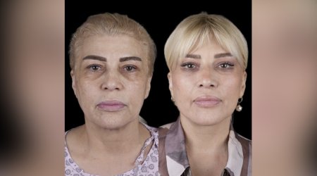 Mətanət İsgəndərli əməliyyatla belə dəyişdi – FOTO