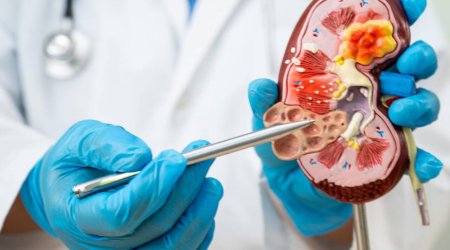 Böyrək daşlarının yaranmasına səbəb olan qidalar açıqlandı