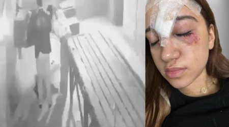 Bakıda qorxu evinə gedən 15 yaşlı qız xəsarət aldı - Alnına 11 tikiş qoyuldu