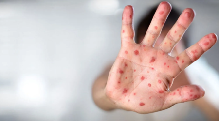 Rusiyada meymunçiçəyinə yeni yoluxma qeydə alınıb