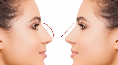 Azərbaycanda bu şəxslərə burun əməliyyatı pulsuz oldu