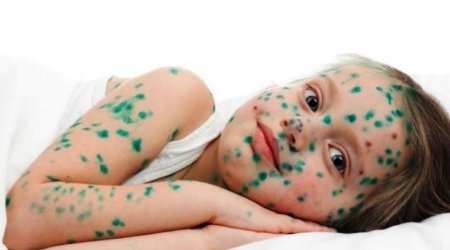 Su çiçəyi yenidən yayılır &ndash; Pediatrdan xəbərdarlıq