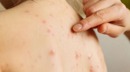 Uşaqlar arasında suçiçəyi yayılıb? &ndash; RƏSMİ AÇIQLAMA