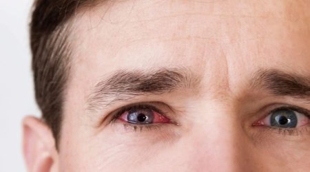 Kişinin gözündən metal parçası çıxarıldı &ndash; FOTO