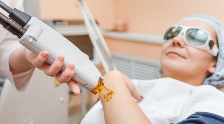 Kosmetoloqlarla dermatoloqlar ÜZ-ÜZƏ - Yayda lazer epilyasiyası olar, ya olmaz?