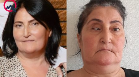Bu klinika təzminat ödəyəcək - Burun düzəldəndə gözü zədələyib &ndash; FOTO