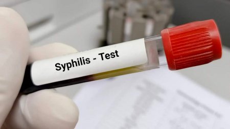 Sifilisə yoluxanların sayı AÇIQLANDI – Uşaqlar da var... – RƏSMİ