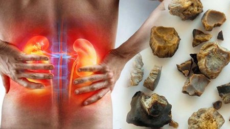 Alimlər böyrək daşlarına yeni çarə TAPDI - FOTO