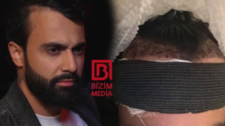 Hüseyn Həsənov saç əkdirdi - FOTO