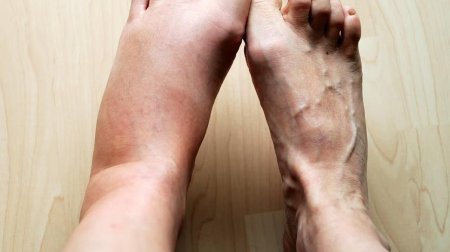 Ödemin gözlənilməz səbəbi AŞKARLANDI: Hansı qidalar şişkinliyi artırır?